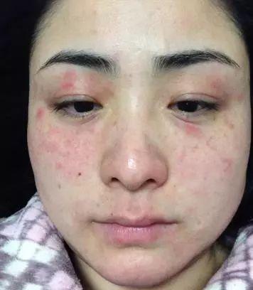 吃海瓜双手过敏,过敏困扰如何解？